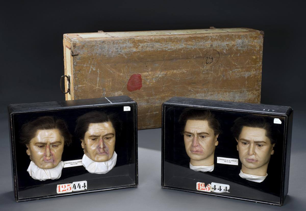 Wax models showing the effects of syphilis symptoms on the face before and after Salvarsan, Germany, ca. 1910. Image courtesy of Wellcome Trust Medical Photographic Library. Creative Commons license CC BY 4.0.