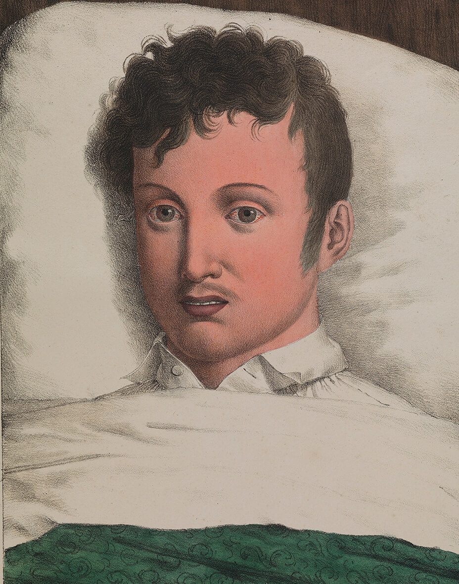 Development of yellow fever 2. Illustration originally published in Etienne Pariset and André Mazet's Observations sur la fièvre jaune, faites à Cadix, en 1819. Courtesy of Wikimedia Commons. Creative Commons license CC BY 4.0. Development of yellow fever 2. Illustration originally published in Etienne Pariset and André Mazet's Observations sur la fièvre jaune, faites à Cadix, en 1819. Courtesy of Wikimedia Commons. Creative Commons license CC BY 4.0.