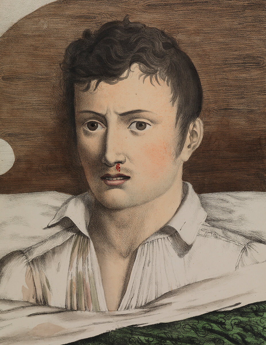 Development of yellow fever 3. Illustration originally published in Etienne Pariset and André Mazet's Observations sur la fièvre jaune, faites à Cadix, en 1819. Courtesy of Wikimedia Commons. Creative Commons license CC BY 4.0. Development of yellow fever 3. Illustration originally published in Etienne Pariset and André Mazet's Observations sur la fièvre jaune, faites à Cadix, en 1819. Courtesy of Wikimedia Commons. Creative Commons license CC BY 4.0.